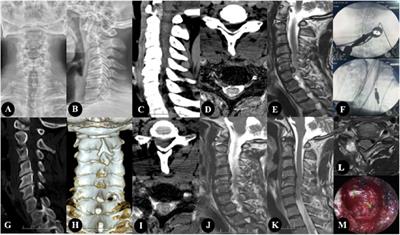 Clinical effect of channel assisted cervical key hole technology combined with ultrasonic bone osteotome in the treatment of single segment cervical spondylotic radiculopathy